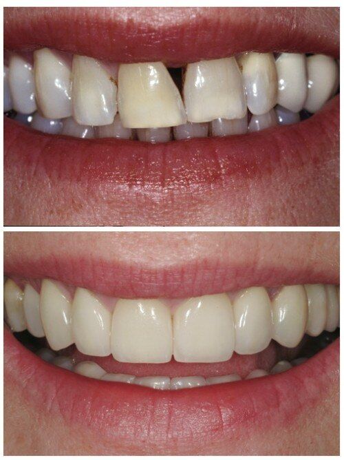 Gap in teeth - before and after