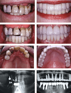 Full mouth rehabilitation of a severe periodontitis case