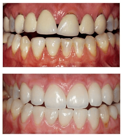 Periodontal disease and yellow teeth