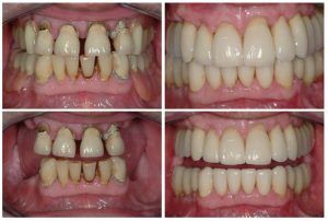 Missing teeth, uncomfortable dentures, diseased and failing teeth (before and after)