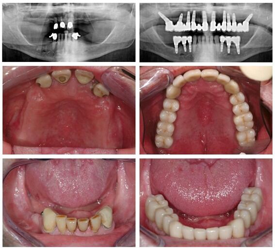 a patient with missing teeth, before & after all on 4 implants, full mouth implants