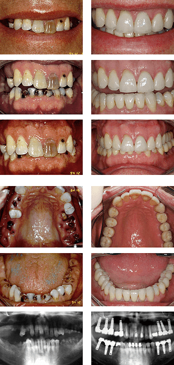 Tooth decay - before and after